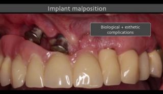 dental implantology courses zurich Dental Campus Association