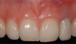 Hopeless lateral incisor in a young patient with a high smile line.