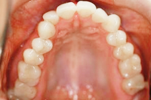 zahnasthetische kurse zurich Fastteeth - Zahnkorrektur für Erwachsene