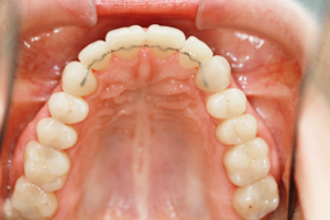 zahnasthetische kurse zurich Fastteeth - Zahnkorrektur für Erwachsene